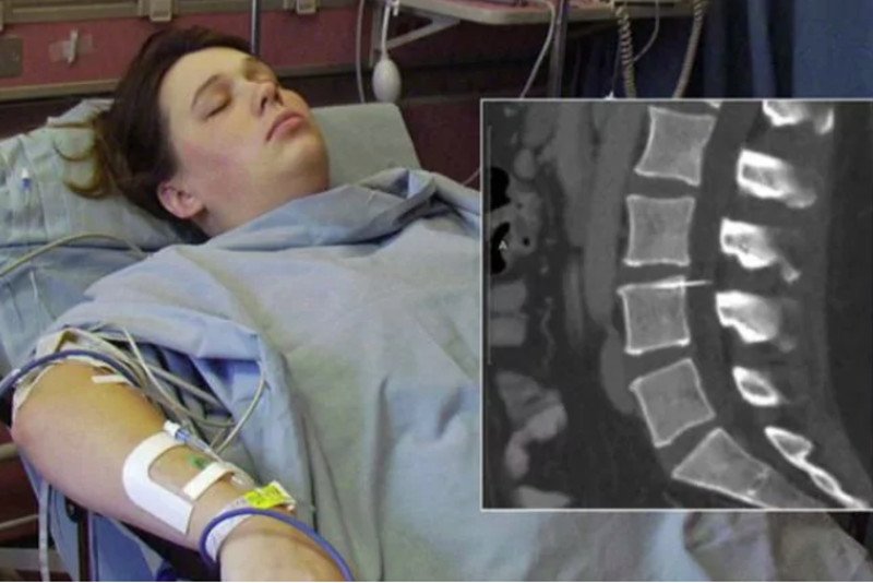 Amy od 14 lat cierpi na bóle kręgosłupa i nóg