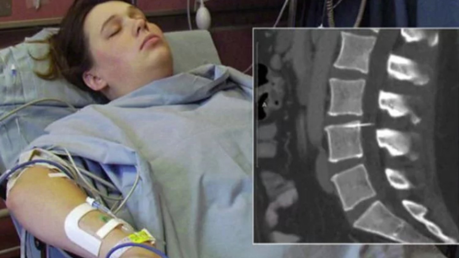 Amy od 14 lat cierpi na bóle kręgosłupa i nóg