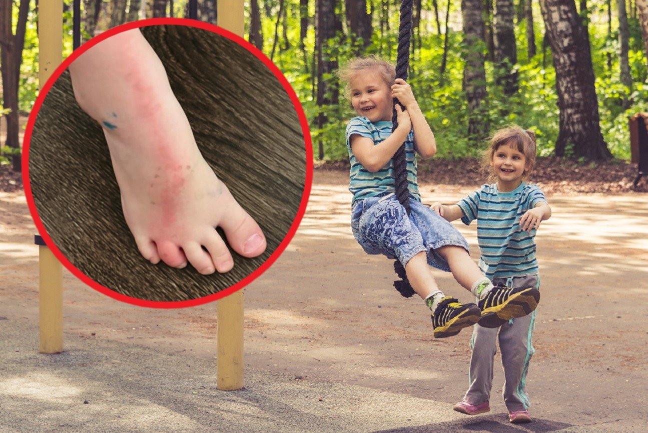 zapalenie naczyń limfatycznych na stopie