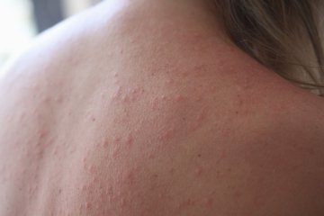 alergia na słońce