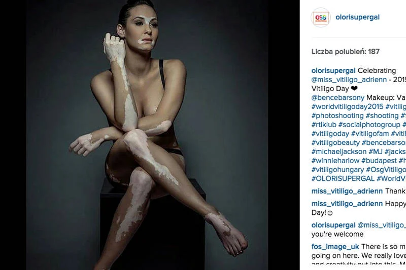 Bielactwo ma bardzo różny przebieg