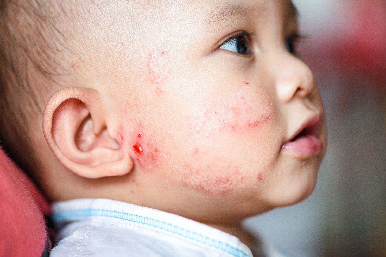 alergia skórna u dziecka