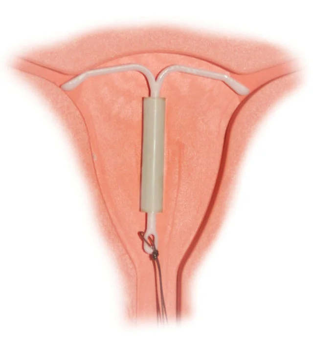 Fot. [url=https://pl.wikipedia.org/wiki/Antykoncepcja#/media/File:Mirena_IntraUterine_System.jpg]Hic et nunc [/url] / [url=http://bit.ly/CC0-PD]CC0 Public Domain[/url]