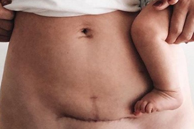 Fotografowanie blizn po cesarce.