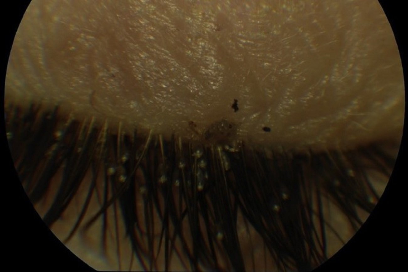 Wesz łonowa, menda, na oku dziecka