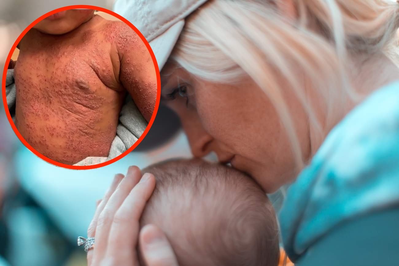 Całą skórę dziecka pokrywały bolesne pęcherzyki. Tak może objawić się "zwykły" wirus