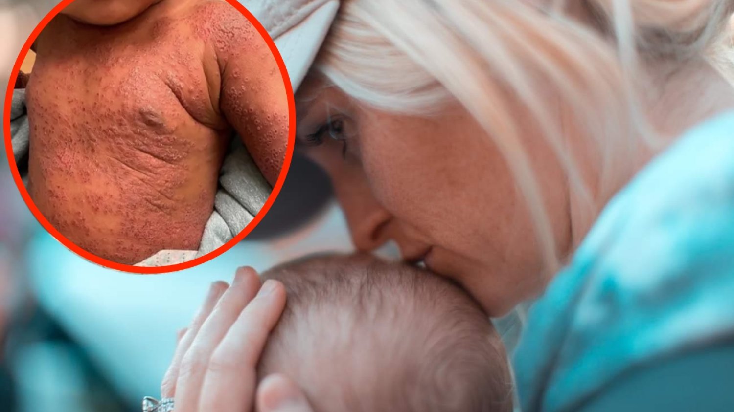 Wirus Herpes: wyprysk opryszczkowy