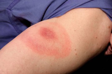rumień po kleszczu, borelioza rumień, rumień wędrujący, ślad po kleszczu, rumień po kleszczu zdjęcia, rumień po kleszczu u dziecka, rumień po kleszczu a borelioza, rumień po ugryzieniu kleszcza, kiedy do lekarz, leczenie