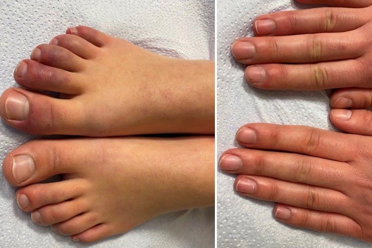 Covidowe palce to rzadki objaw covid-19