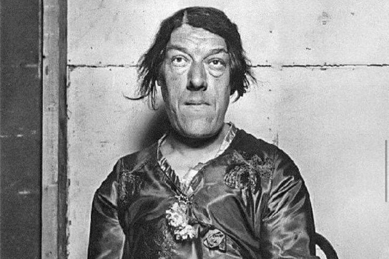 Mary Ann Bevan z powodu swojej choroby została okrzyknięta najbrzydszą kobietą świata.