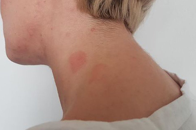 Objawy uczulenia na hybrydę