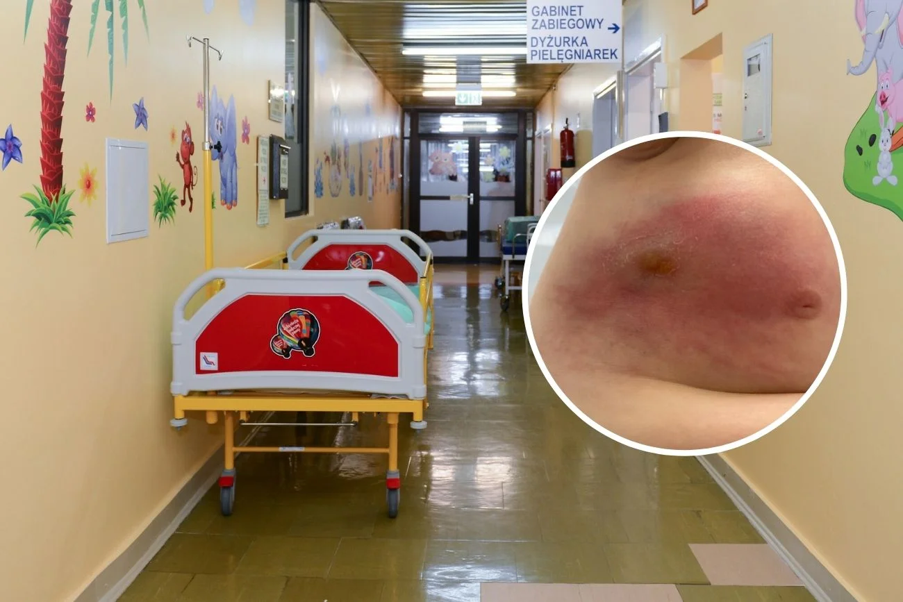 Szpitalny korytarz na oddziale pediatrii i zdjęcie nacieku zapalnego tkanki podskórnej.