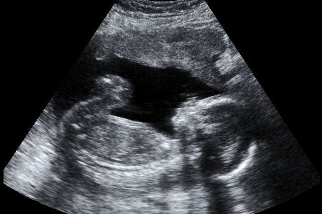 jak wygląda dziecko w 4 miesiącu ciąży