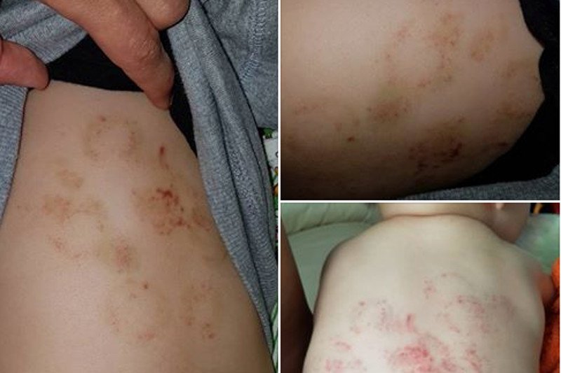 Mama zauważyła pogryzienia na plecach dziecka.