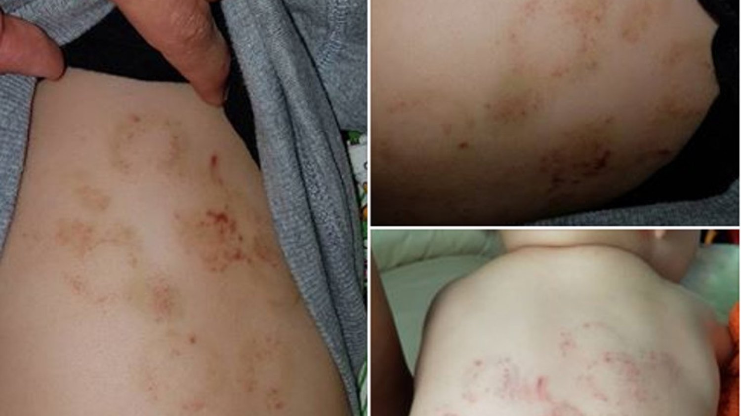 Mama zauważyła pogryzienia na plecach dziecka.