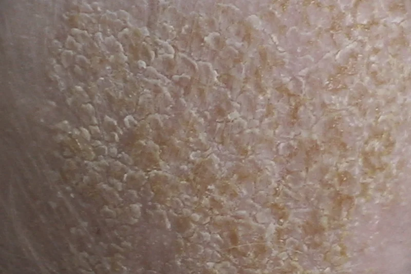 Ciemieniucha nie boli i nie swędzi, ale wygląda nie najlepiej, więc nie dziwi fakt, że rodzice chcą pozbyć się jej z główki dziecka. Strupków nie wolno jednak na siłę zdrapywać  – takie postępowanie grozi zakażeniem