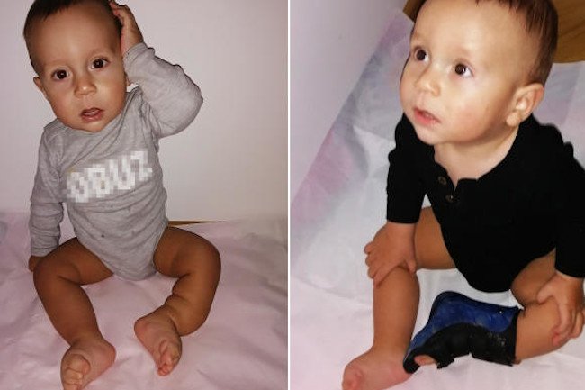 Natan Kalista - operacja na zdeformowaną nogę