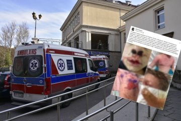 ospa wietrzna, powikłania po ospie, powikłania ospy zdjęcia